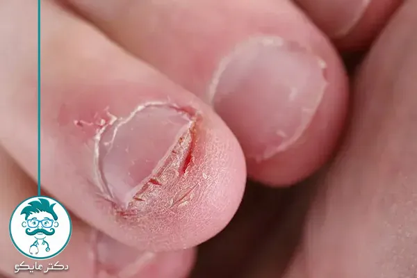 برنامه‌ی ۳۰ روزه برای ترک خوردن ناخن