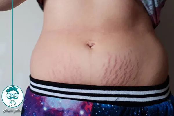 علائم کورتیزول بالا در زنان