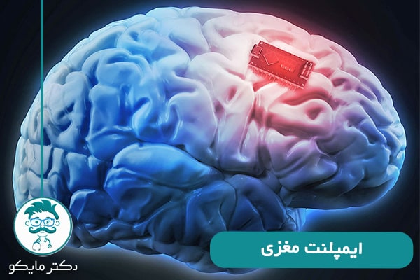ایمپلنت مغزی
