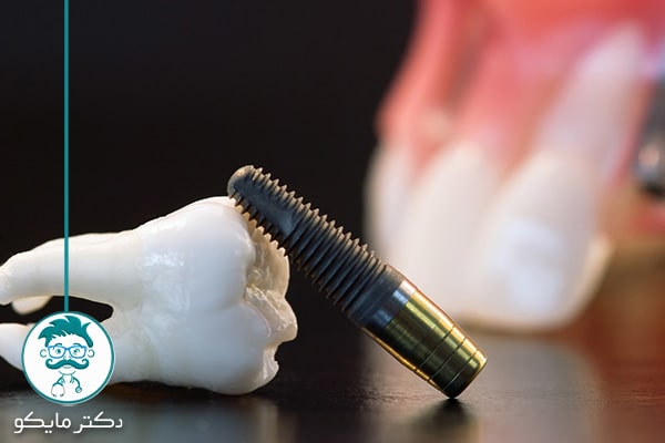 ایمپلنت دندان برای بیماران قلبی