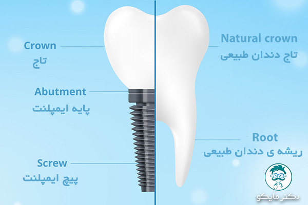 ساختار دندان ایمپلنت و طبیعی