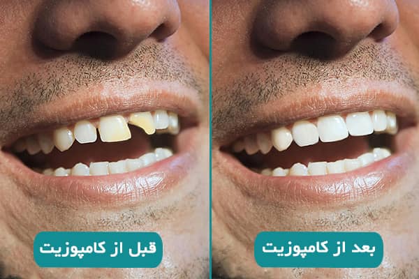 مراحل کامپوزیت دندان Dental composite