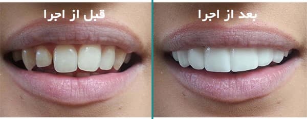 تصویر قبل و بعد از لمینت دندان