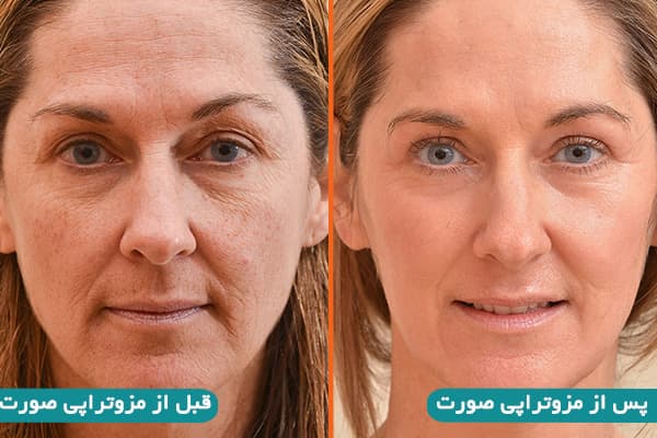 قبل و بعد از مزوتراپی پوست 
