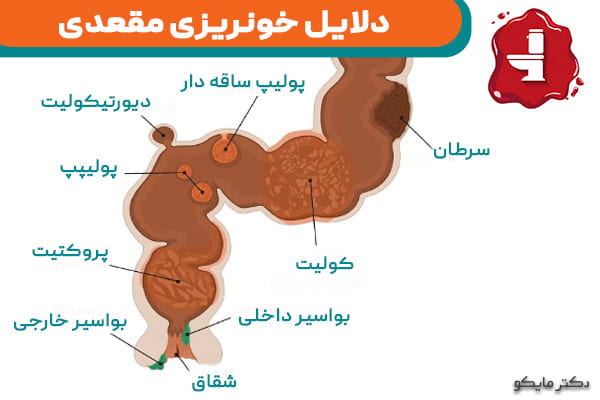 علت خونریزی از رکتال چیست؟
