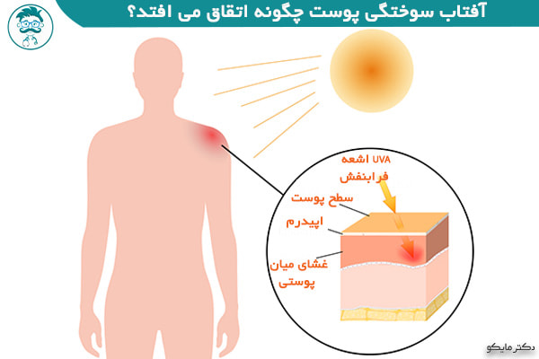  آفتاب سوختگی پوست صورت و بدن چگونه اتفاق می افتد؟