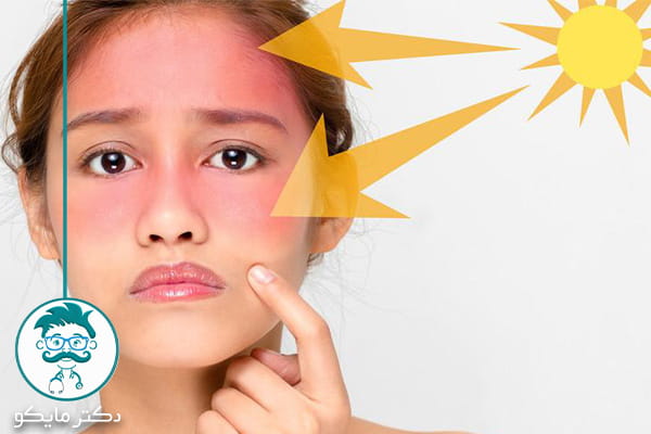 درمان خانگی آفتاب سوختگی صورت