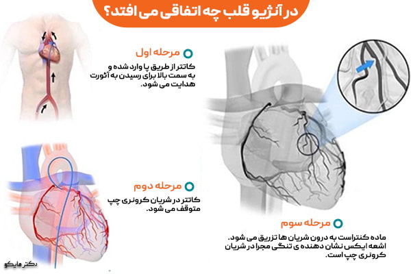 مراحل عمل آنژیوگرافی قلب چیست؟