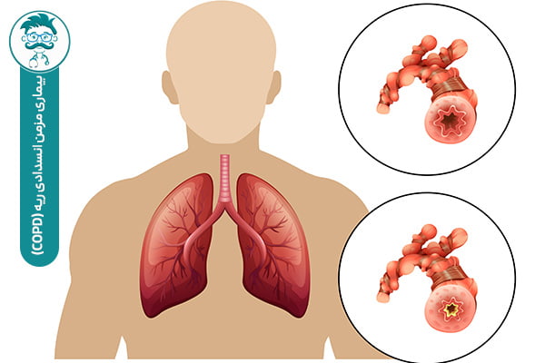 بیماری مزمن انسدادی ریه (COPD)