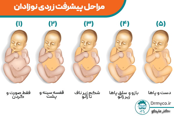 مراحل پیشرفت زردی در نوزادان