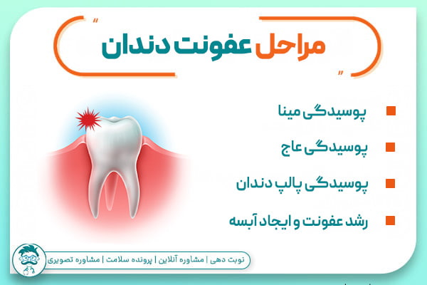 مراحل عفونت دندان