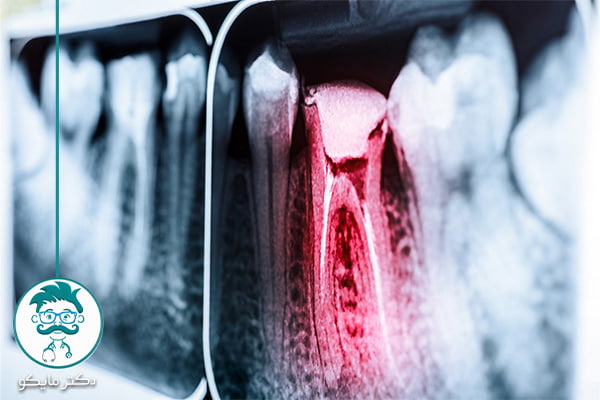 تشخیص عفونت دندان