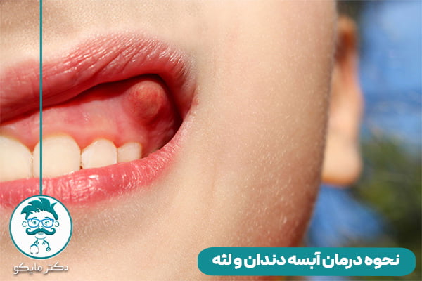 درمان آبسه دندان چیست؟ 