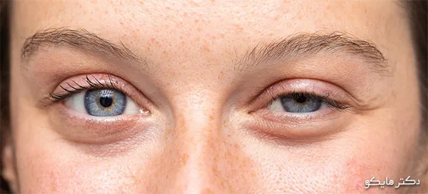 درمان افتادگی پلک چشم