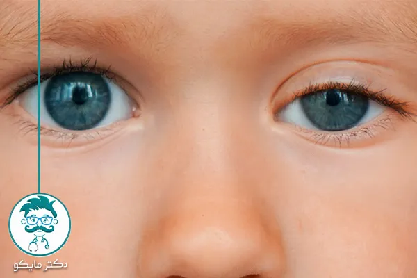 عصای پتوز درمان سریع افتادگی پلک چشم