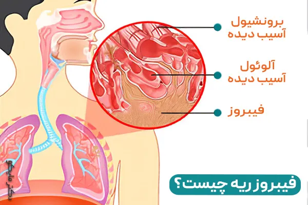 فیبروز ریه چند نوع است؟