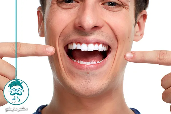 بلیچینگ دندان برای انواع لکه ها