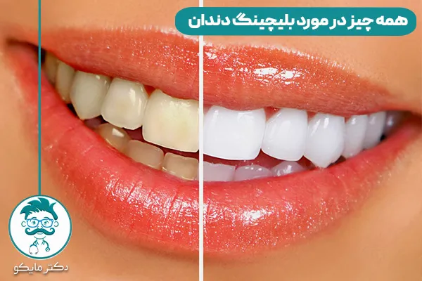 سفید کردن با بلیچینگ دندان 