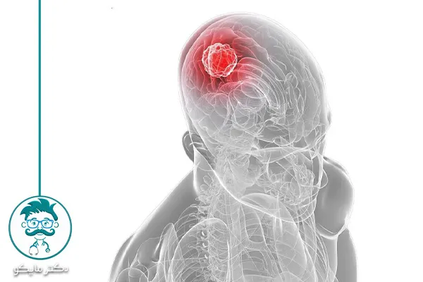 فلج شدن بعد از عمل تومور مغزی چقدر ممکن است؟