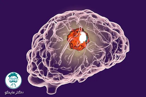هزینه عمل جراحی تومور مغزی چقدر است؟