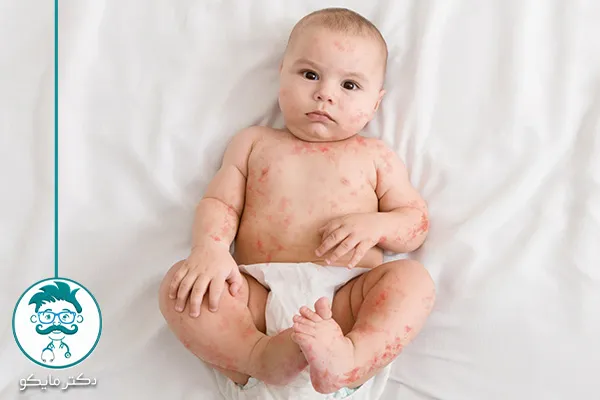علل ایجاد راش پوشک در نوزاد