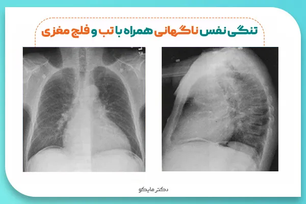 تصویر ریه در هنگام تنگی نفس