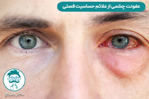 عفونت چشم ها در اثر حساسیت