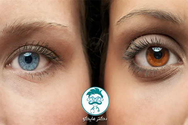 تغییر رنگ چشم ها به چه عواملی بستگی دارد؟
