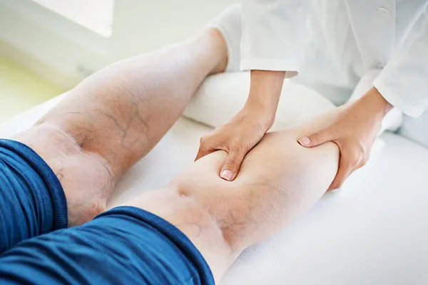 بیماری واریس پا چیست؟ علائم، علت، پیشگیری و معجزه درمان سریع واریس پا
