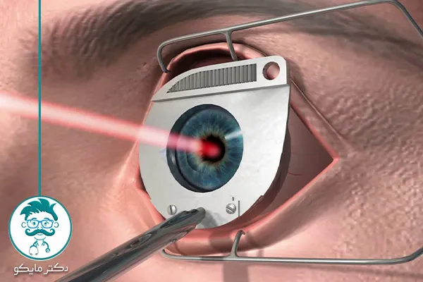 عمل لیزیک چشم چگونه انجام می شود؟