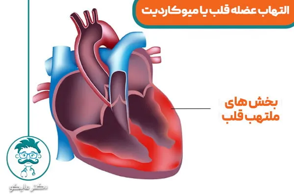 التهاب قلب یا میوکاردیت چیست؟
