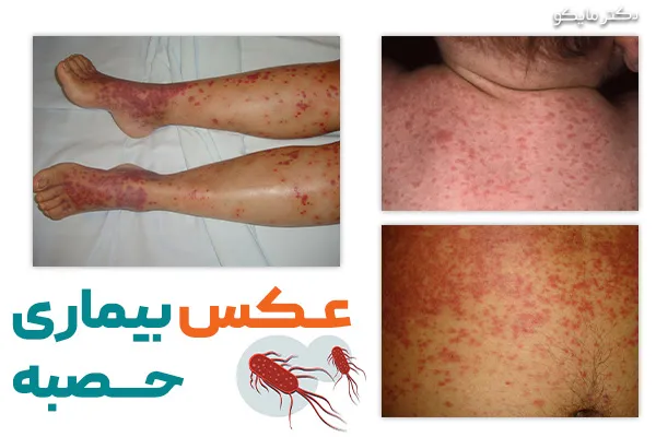 عکس بیماری حصبه در بزرگسالان و کودکان