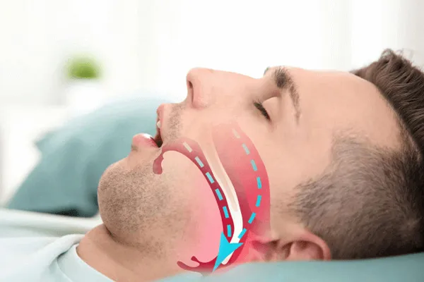 آپنه خواب چیست؟ علت و علائم وقفه تنفسی در خواب + درمان قطعی