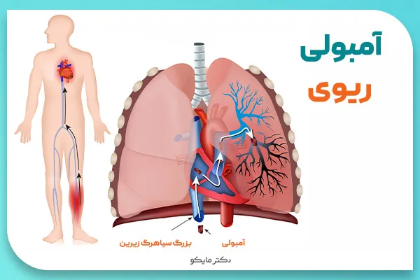 آیا آمبولی ریه خطرناک است؟