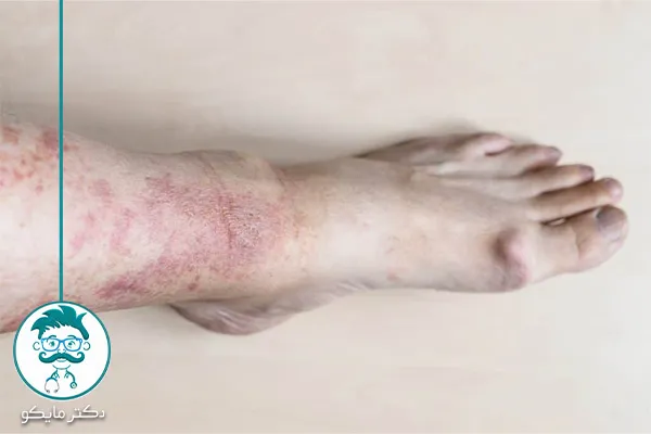 انواع بیماری‌های پوستی پا