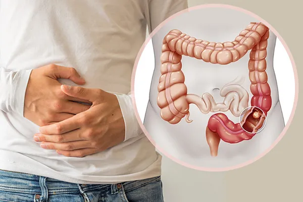 سرطان روده چیست؟ علت و علائم سرطان روده بزرگ و کوچک، طول عمر + میزان کشنده بودن