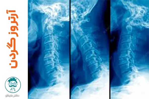 آرتروز گردن چیست؟