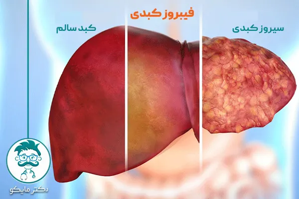 فیبروز کبدی چیست؟