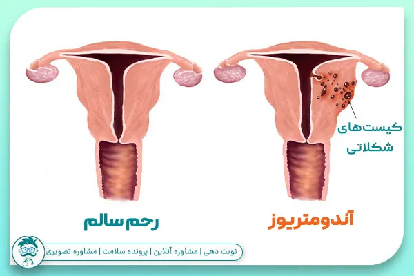 آندومتریوز چیست؟