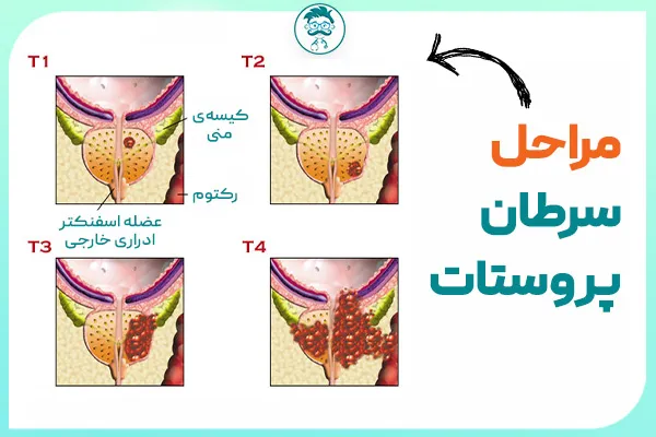 علائم عود سرطان پروستات در مراحل مختلف