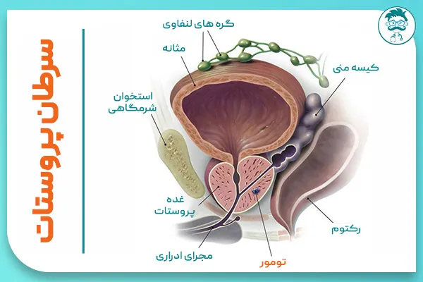 آخرین مرحله سرطان پروستات: سرطان پروستات گرید ۴