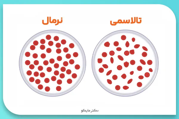 تالاسمی چیست؟