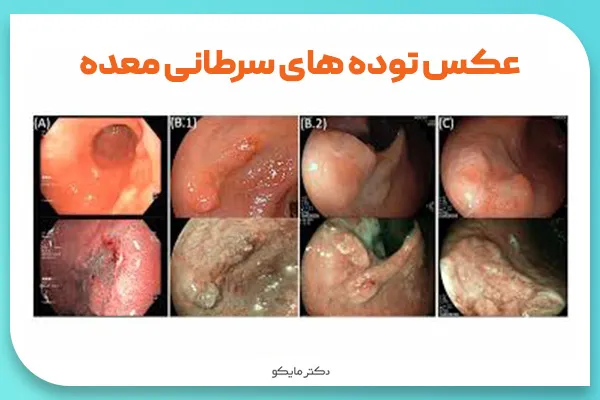 عکس سرطان معده بدخیم