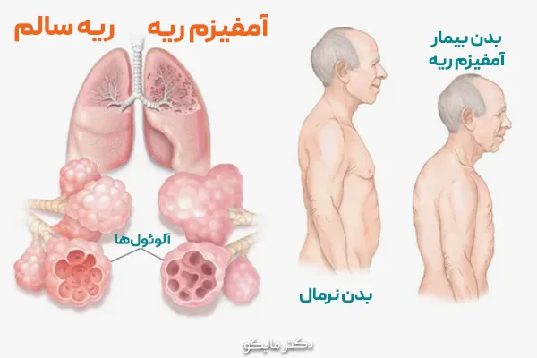 صدای ریه در آمفیزم