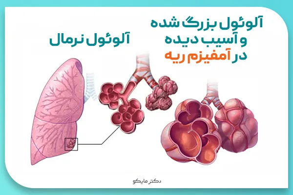 دارو آمفیزم ریه