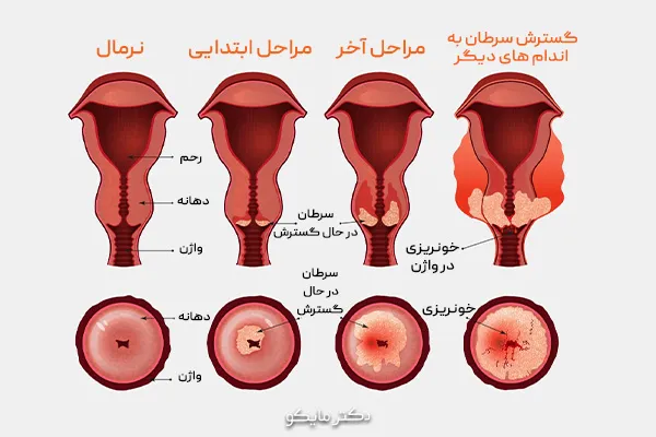 عکس سرطان دهانه‌ی رحم مراحل پیشرفت