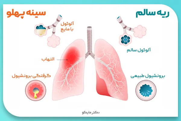 سینه پهلو نوزاد