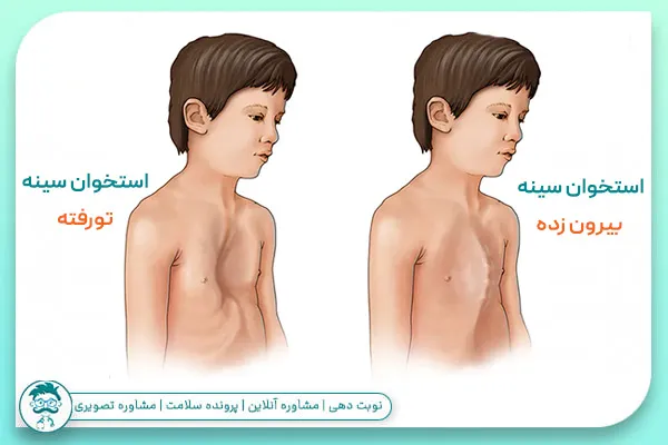 علائم سندرم مارفان چیست؟