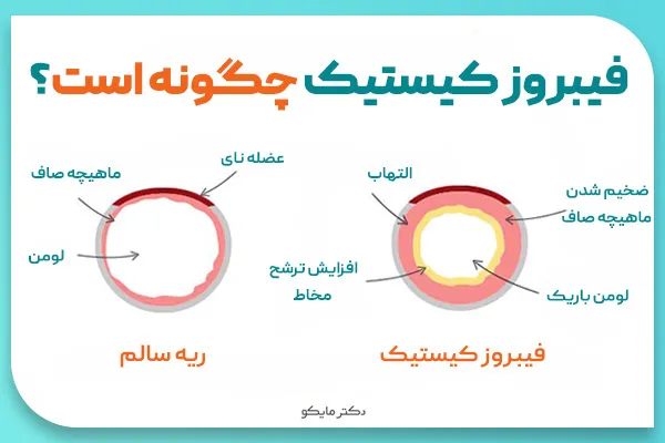 فیبروز کیستیک چیست؟