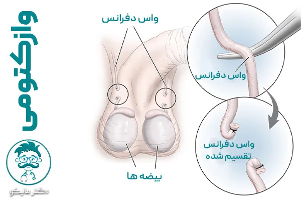 جراحی وازکتومی 